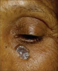 BCC pigmented type