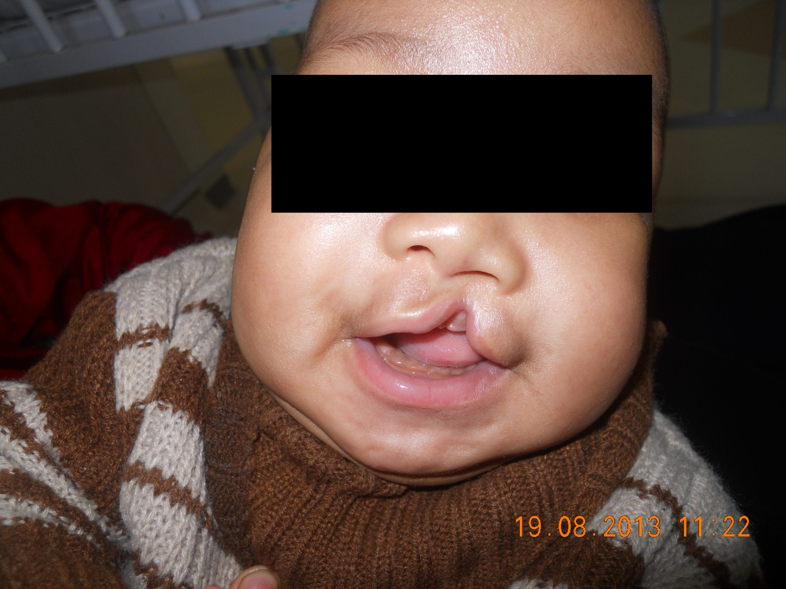 pre cleft lip photo