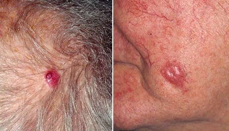 Merkel cell carcinoma