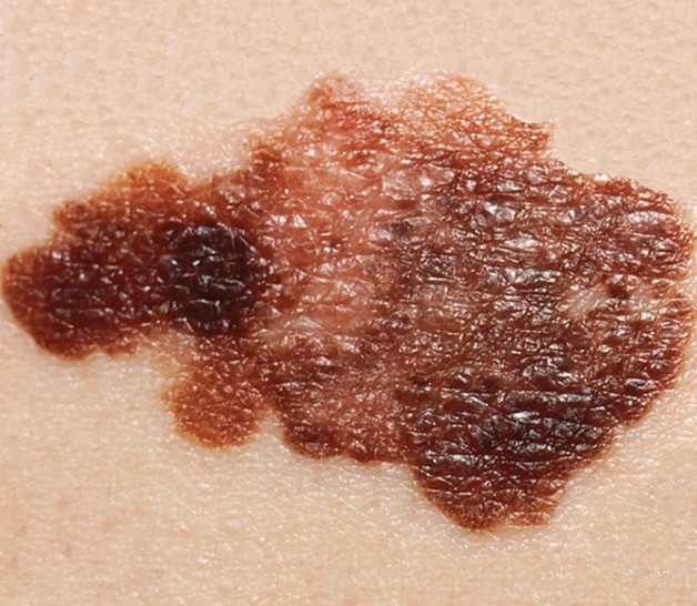 melanoma skin cancer symptoms
