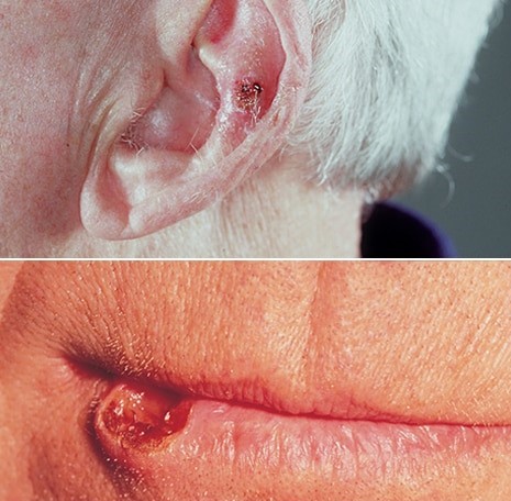 Squamous cell carcinoma of the skin